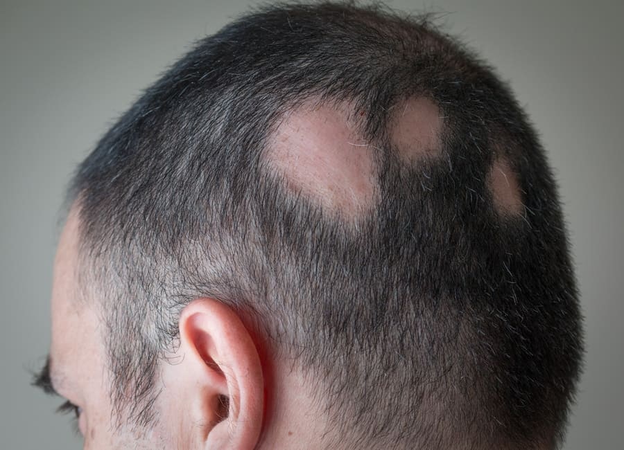 Die Haarfrage: Wie viele Haare hat ein Mensch?